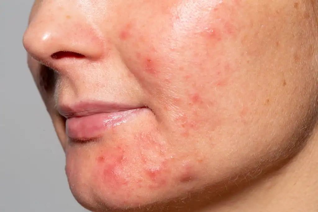 Breakouts & Blemishes