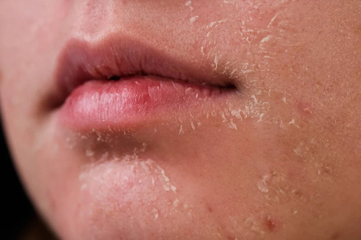 Dryness