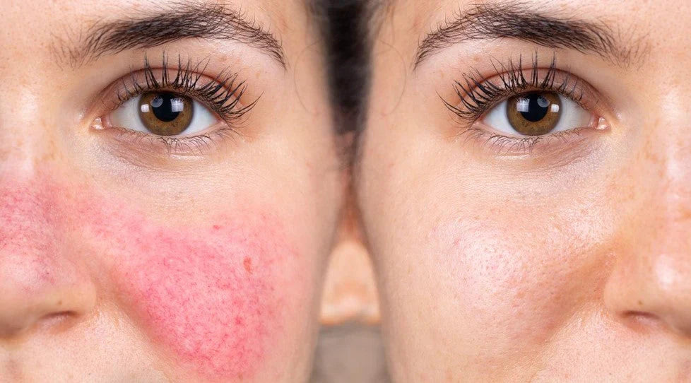 Sensitive & Rosacea-Prone