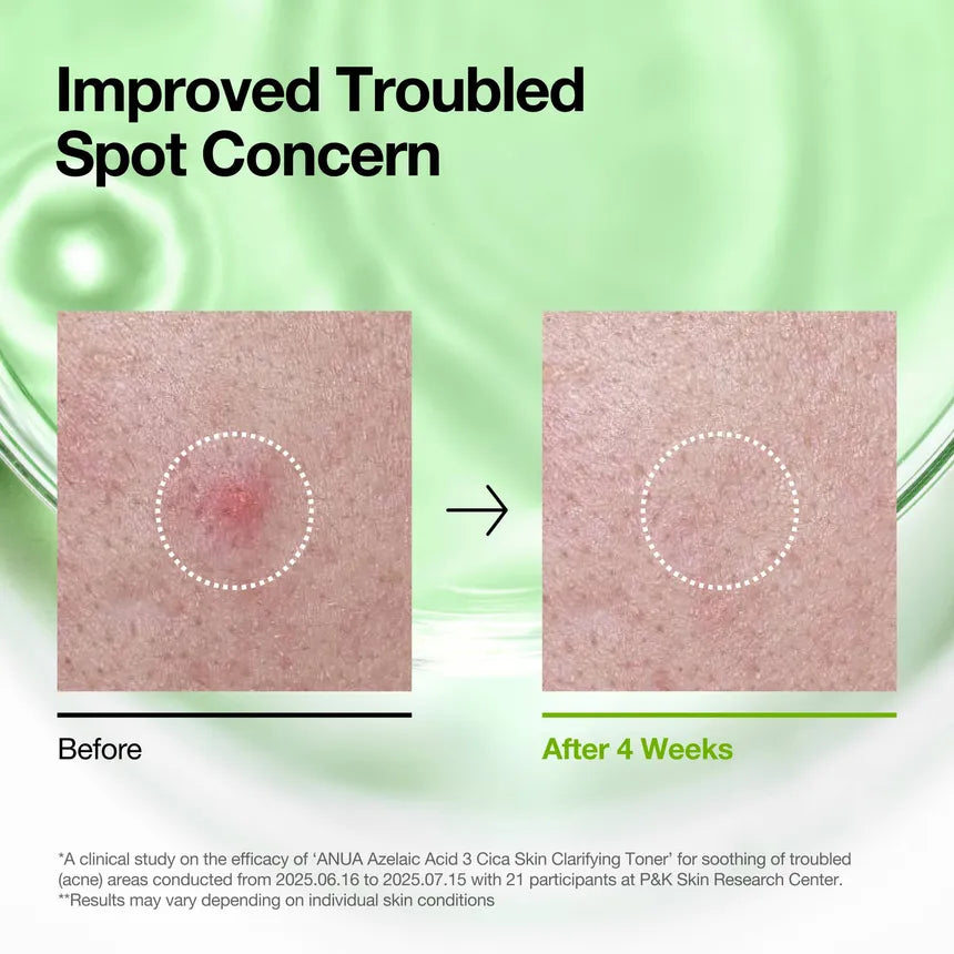 Anua - Azelaic Acid 3 Cica Skin Clarifying Toner - Gallery 4