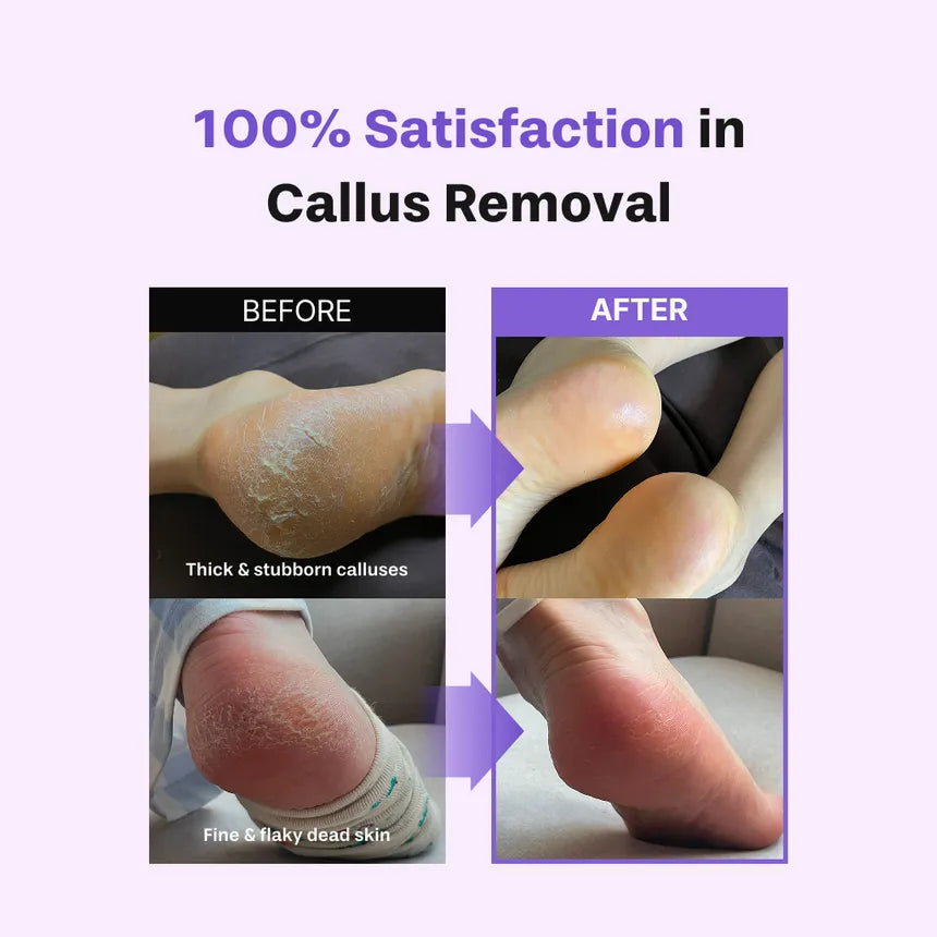 baren - Callus Remover Kit for Feet: Foot File & Peeling Foot Spray - Gallery 7