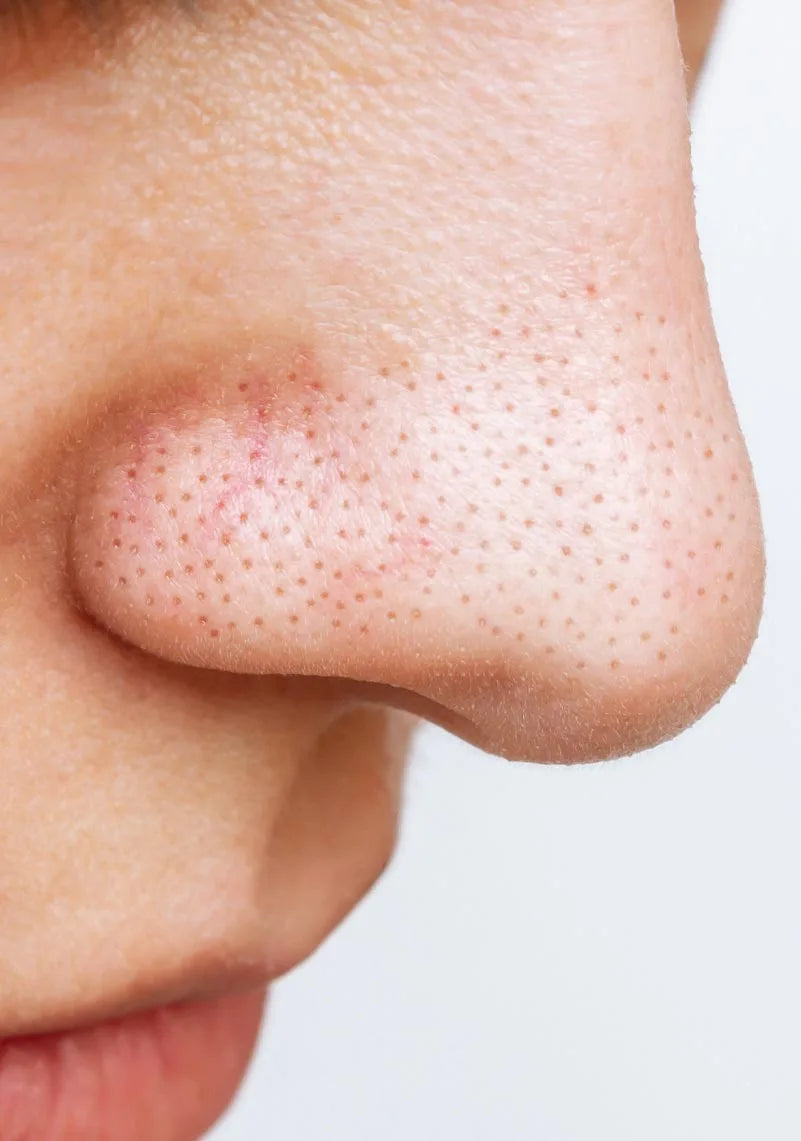 Blackhead-prone